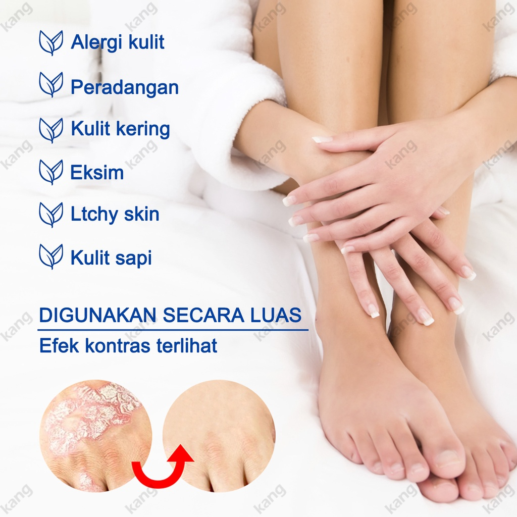 【100% ORIGINAL】[BPOM&amp;COD]Salep gatal Salep Eksim Salep kulit Krim psoriasis paling ampuh Kulit Kepala Psoriasis Tangan Tinea Kaki Bau