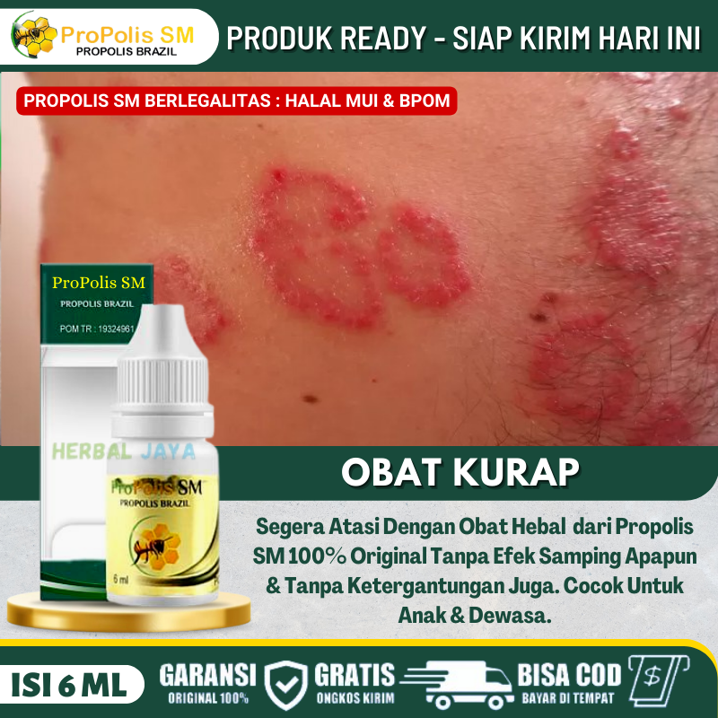 Obat Tetes Kurap, Basmi Kurap, Basmi Jamur, Penghilang Ruam Merah Pada Kulit, Penghilang Gatal - Gat