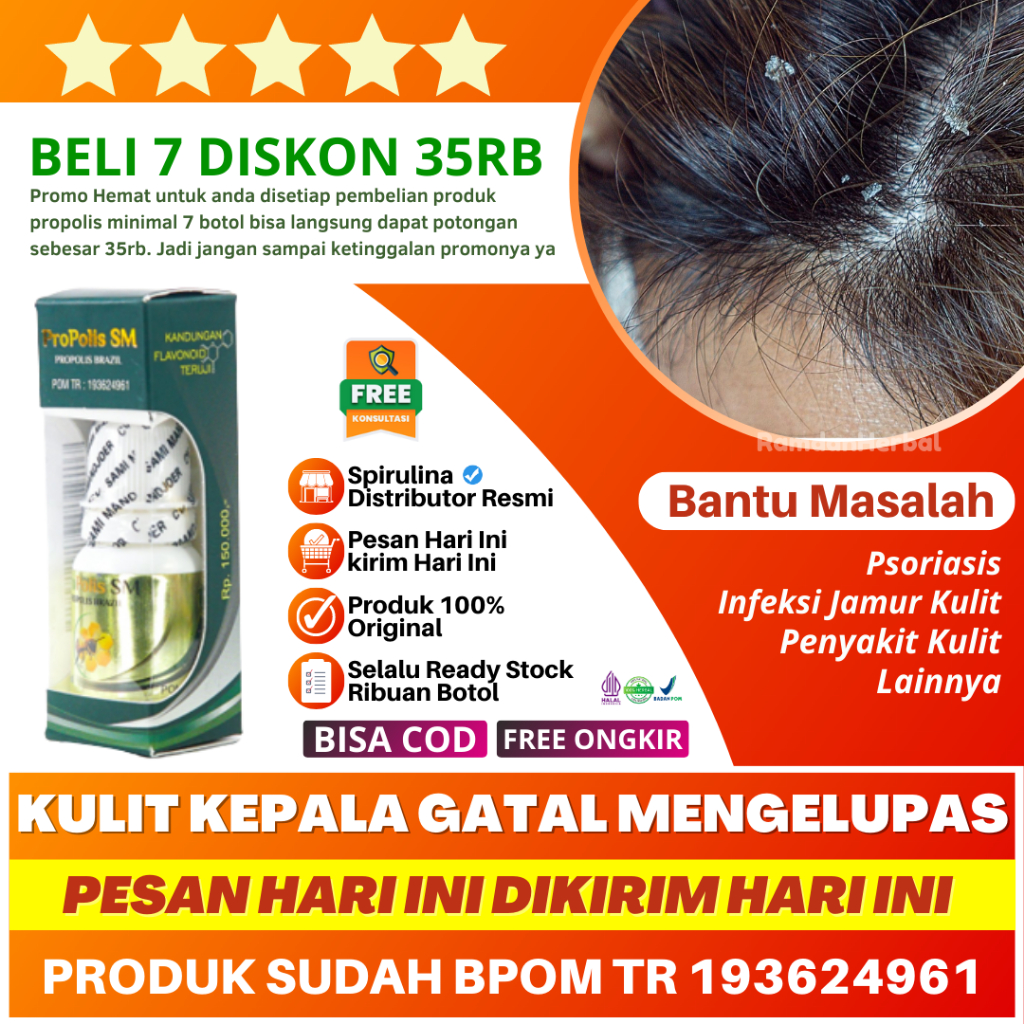 Obat Kulit Kepala Gatal Dan Mengelupas Gatel Kulit Kepala Anak Dewasa Lansia Psoriasis Jamur Kulit G