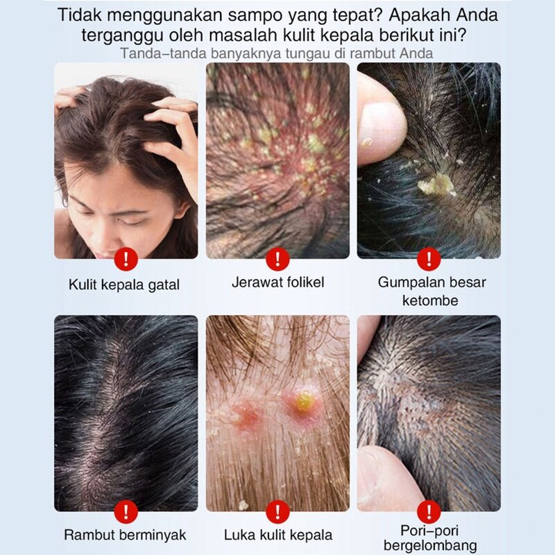 Obat ketombe Sampo ketombe Obat Ketombe Rambut Rontok Berkerak Sampo 300ML Efesiensi menghilangkan ketombe/Cepat anti gatal/Memuluskan rambut/Menjaga kulit kepala