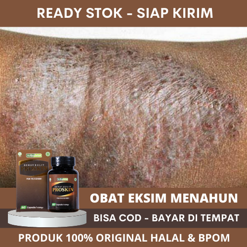 Obat Eksim, Obat Eksim Menahun, Obat Herbal Eksim Kering, Obat Eksim Basah, Obat Oles Exim, Obat Gat