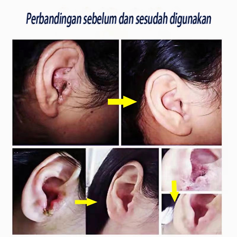 Obat Tetes Telinga ,Obat Tetes Kotoran Telinga, Penghancur Kotoran Telinga Keras Kering Menumpuk - O