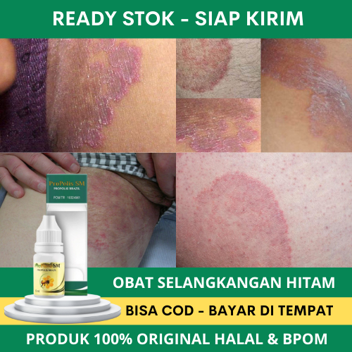 Obat Selangkangan Hitam, Obat Gatal Selangkangan, Obat Selangkangan Berjamur, Obat Eksim Selangkanga