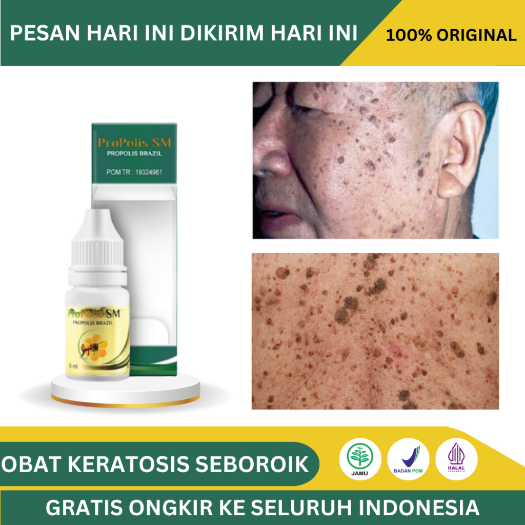 Obat Keratosis Seboroik, Penghilang Bintik Hitam Seperti Kutil Di Wajah, Kanker Kulit Melanoma, Kera