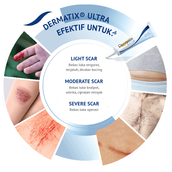 Dermatix Ultra 15gr ORIGINAL untuk Bekas Luka, Keloid, ANTI SCAR Stretchmark 15 Gram