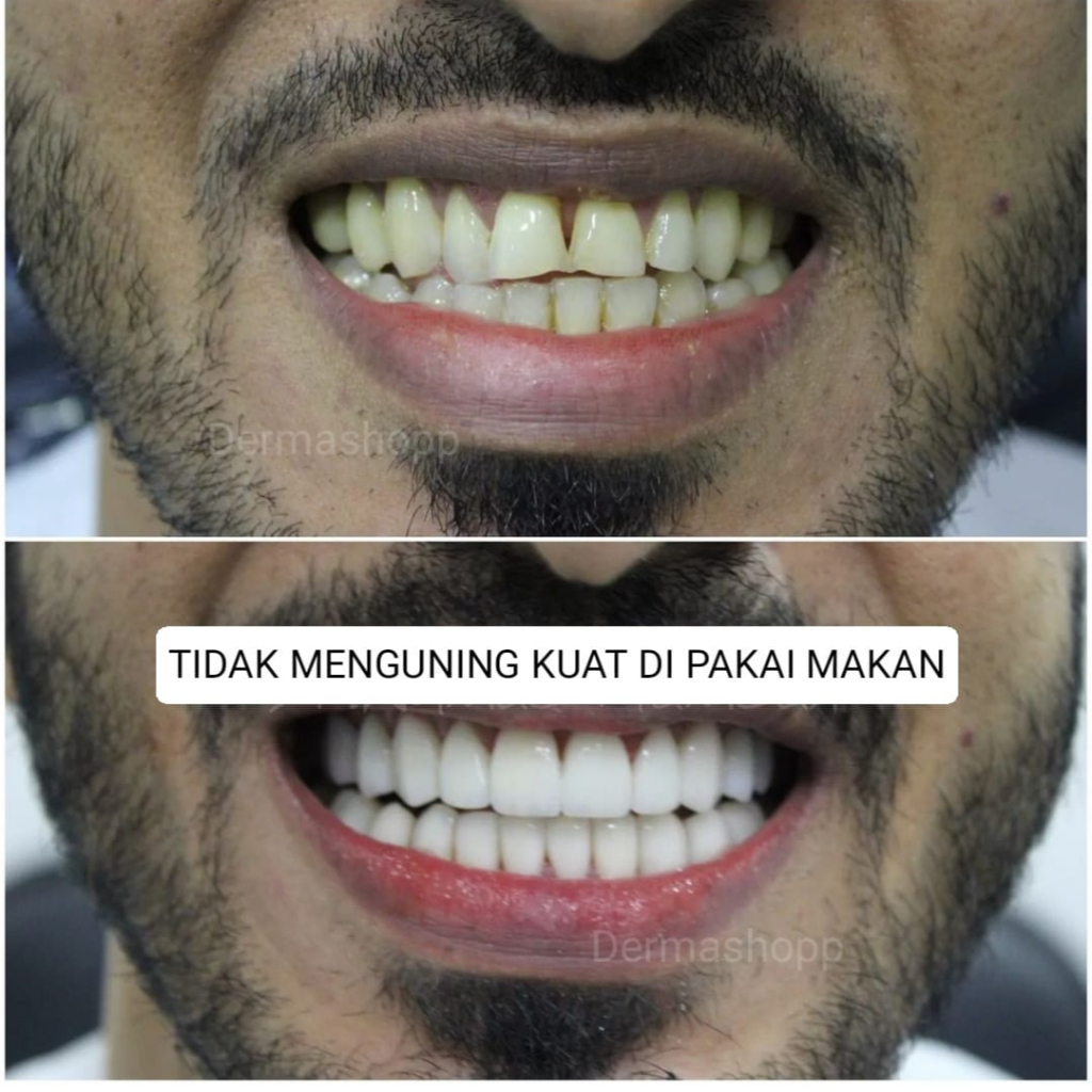 Gigi Palsu Atas Bawah Snap on smile original Gigi palsu permanen kuat tahan lama Veneer vener gigi p