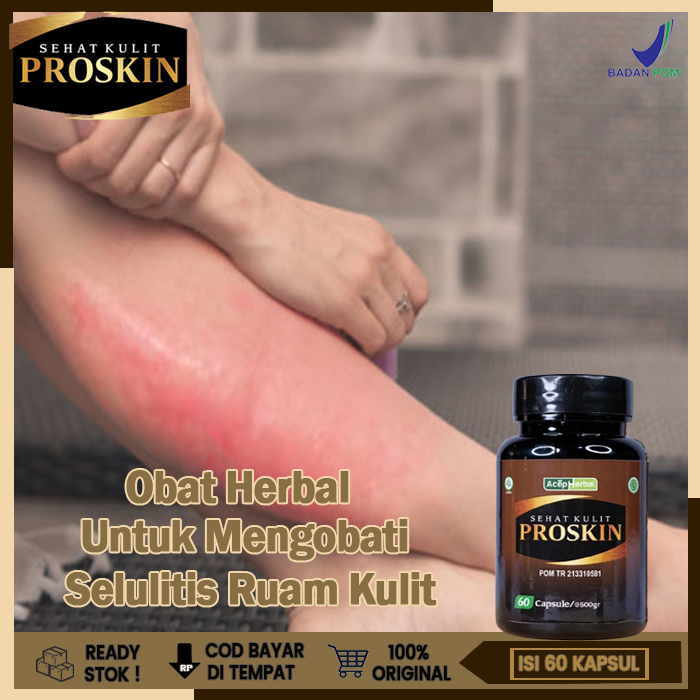 Obat Selulitis Ruam Kulit Kemerahan, Obat Infeksi Bakteri Kulit Kemerahan Panas, Obat infeksi Kulit 