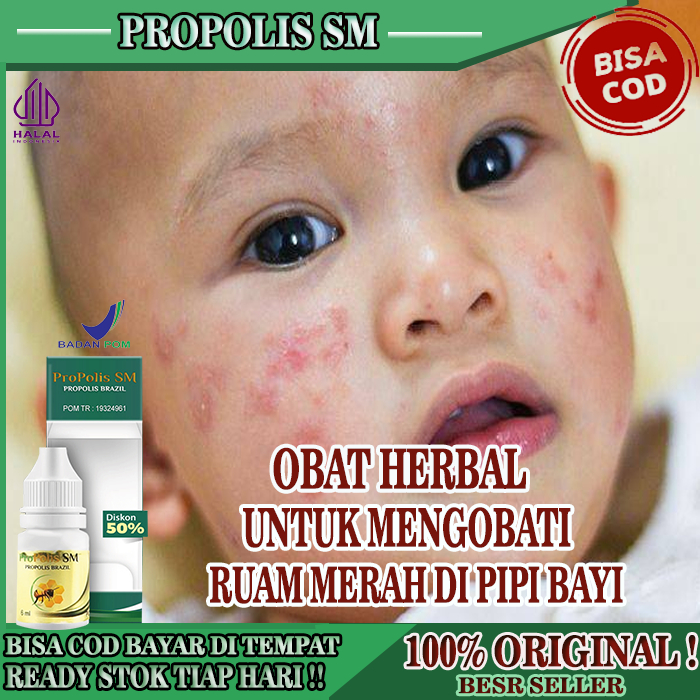 Obat Ruam Pipi Bayi, Biang Keringat Bayi Di Wajah, Penghilang Ruam Merah Gatal Pada Bayi, Ruam Pipi 
