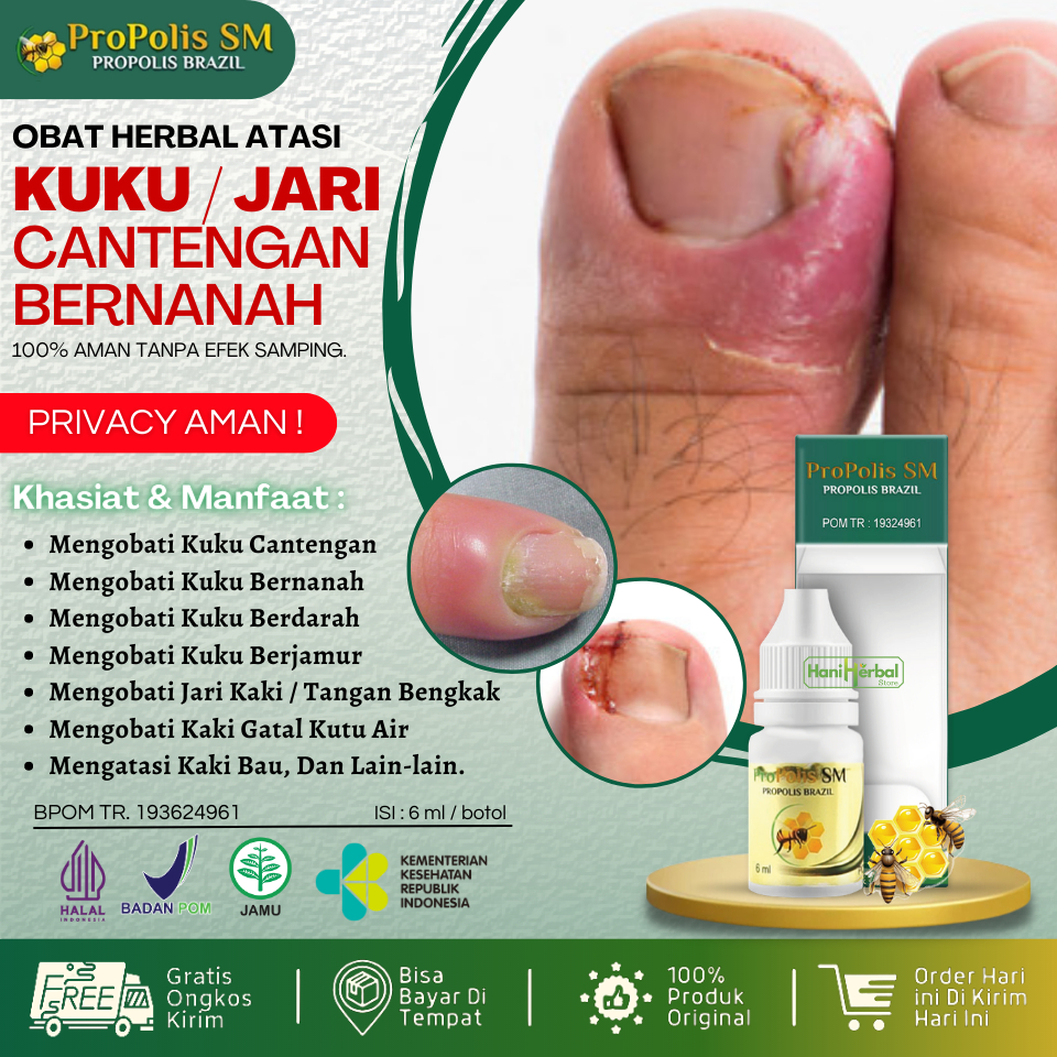 Obat Cantengan Jempol Kaki Bengkak Bernanah Berdarah Kuku Rusak Jamuran Kutu Air Jari Kaki Tangan - 