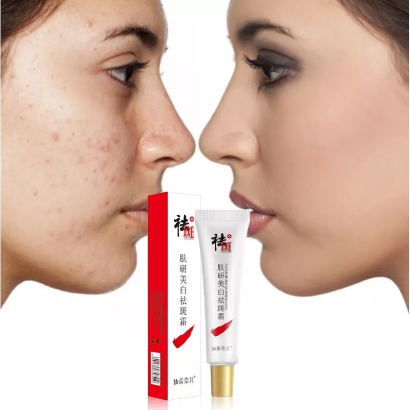 [ ORIGINAL ] CINDYNAL Whitening Freckle Cream Remove Dark Spots Penghilang Flek/Jerawat/Bintik Noda 