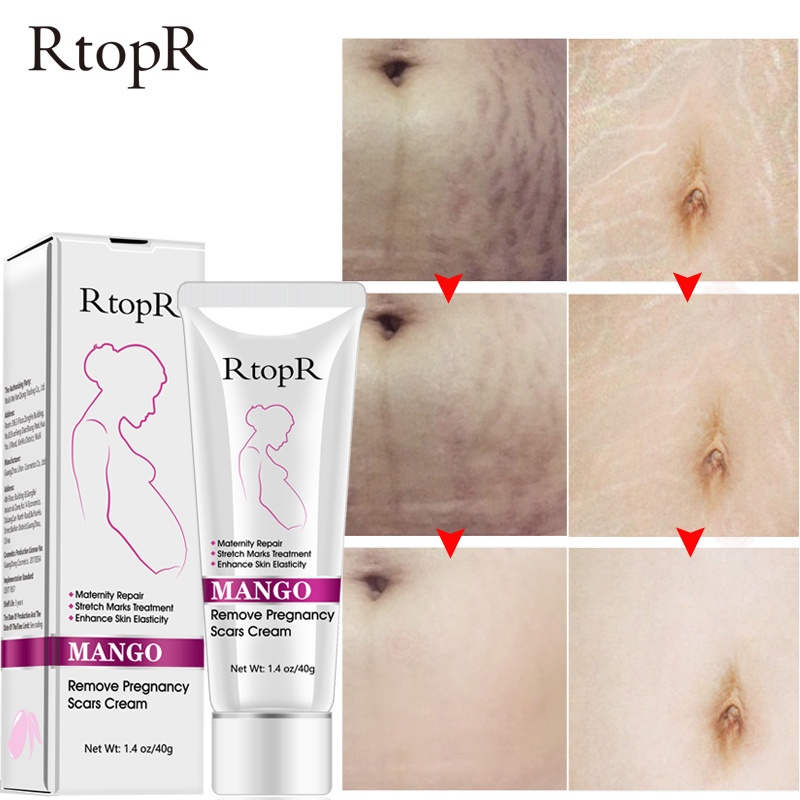 RtopR MANGO Remove Pregnancy Scars Cream Krim Anti Penuaan dan Keriput, Perawatan Stretch Mark, Krim Jerawat Penghilang Bekas Hamil, Krim Pengencang Tubuh