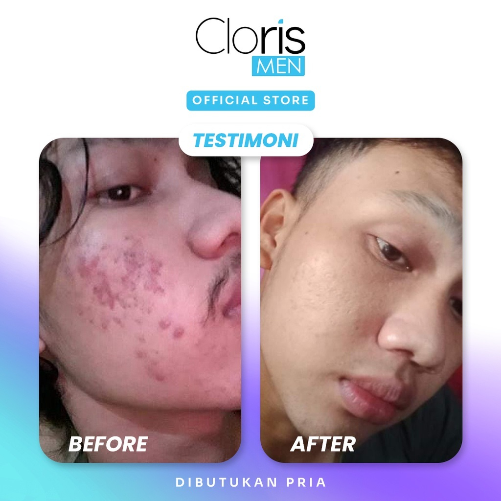 Paket Skincare Cowok Clorismen Acne Series Sabun Serum Atasi Bekas Jerawat Perawatan Pria C12