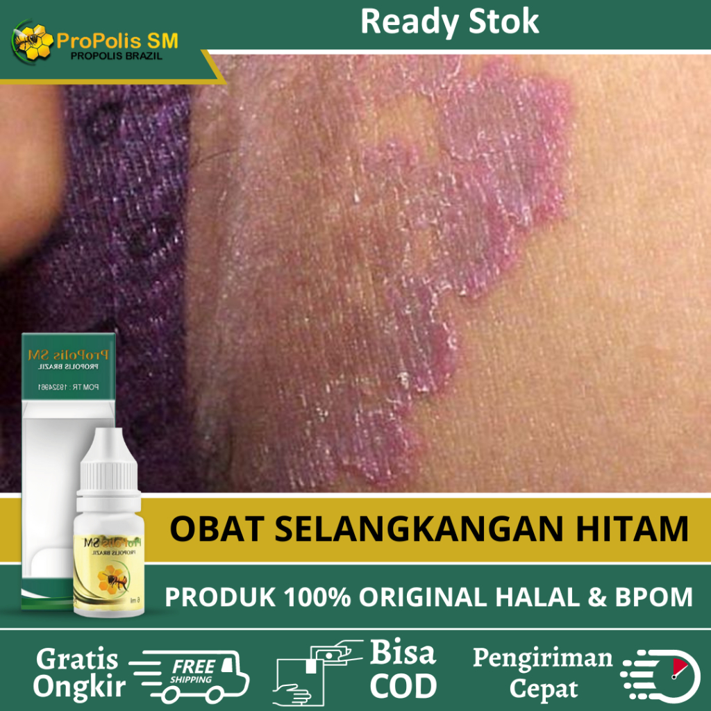 Obat Selangkangan Hitam Dan Gatal, Obat Gatal Selangkangan, Obat Gatal Selangkangan Gatal Dan Hitam,