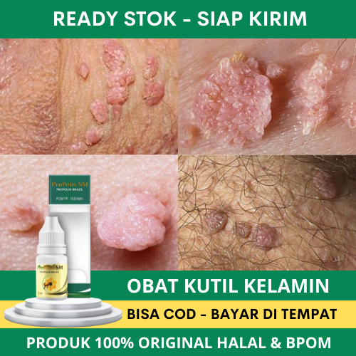 Obat Perontok Kutil Kelamin, Obat Kutil Kelamin, Kutil Kelamin Pria, Kutil Kelamin Wanita, Salep Pro