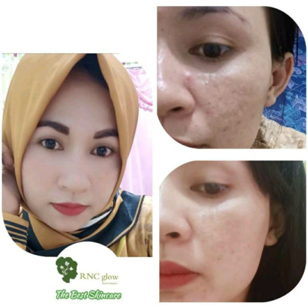 PAKET PEMUTIH RNC GLOW 100 % ORIGINAL BPOM HALAL, AMAN UNTUK BUMIL DAN BUSUI, Mengatasi flek dan ber