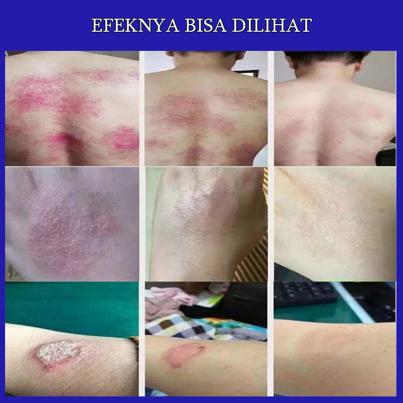 OBAT GATAL KULIT OBAT GATAL KULIT PALING AMPUH Salep gatal Salep Eksim 20g Psoriasis Salep Antibiotik  Krim Gatal Anti Bakteri Anti Gatal Di Tangan/Anti Gatal Di Kaki/Anti Gatal Di Kemaluan/Anti Gatal Di Bpom