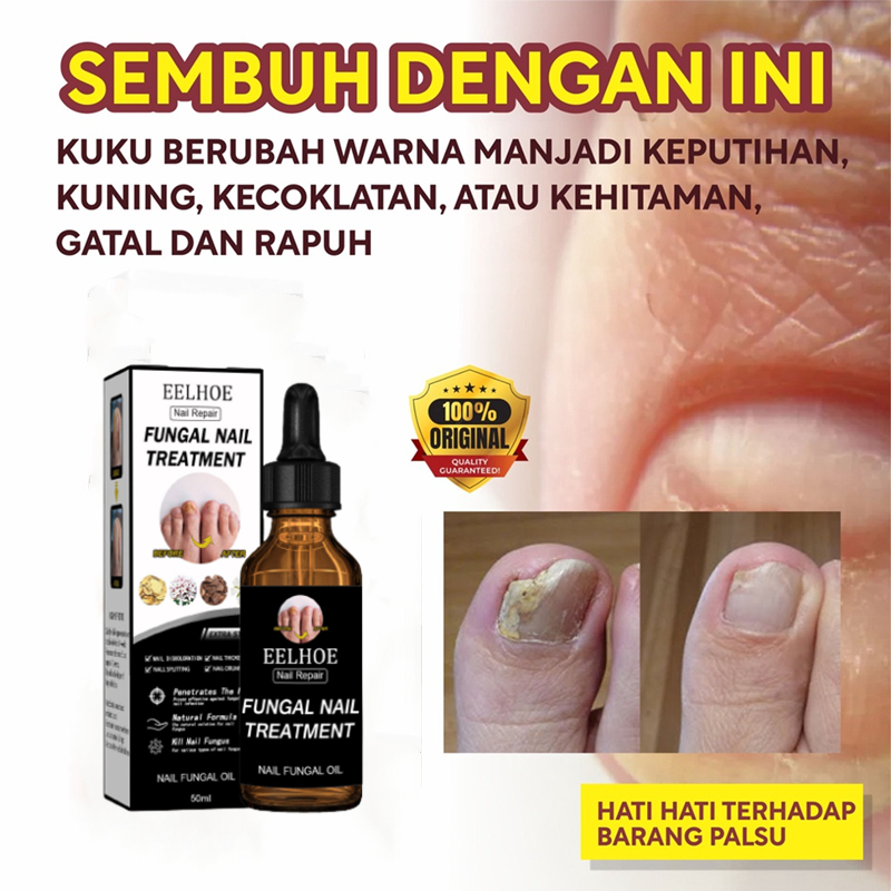 Obat Jamur Kuku Obat kuku jamur dan rusak Perawatan Kuku Berjamur Antibakteri Perawatan Kuku Onikomikosis Paronychia Anti Infeksi Kuku Toe Nail Pengobatan Jamur Minyak Nail Repair Essence Serum