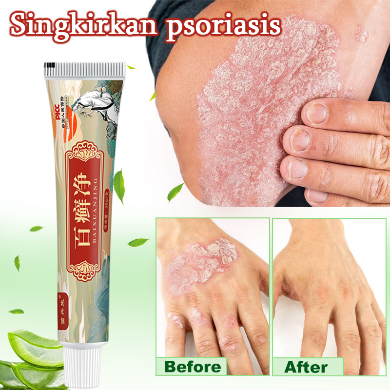 Obat Gatal Salep Obat Gatal Kulit Krim Gatal 20ml Salep antibiotik psoriasis antibakteri gatal krim krim dermatitis dan psoriasis psoriasis eksim eksim antid gatal salep