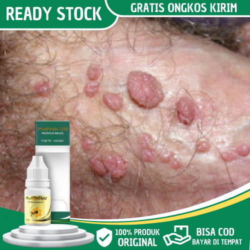 Obat Kutil Kelamin, Obat kutil Kelamin Pria Dan Wanita, Obat Kutil Kelamin Hpv, Perontok Kutil Kelam