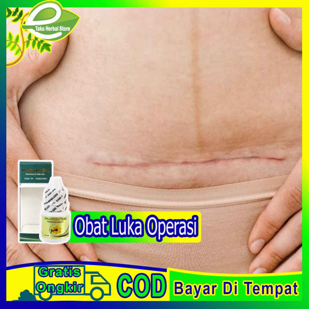 Obat Luka Operasi, Obat Pengering Luka, Obat Pengering Luka Operasi Sesar/Caesar, Obat Pasca Operasi