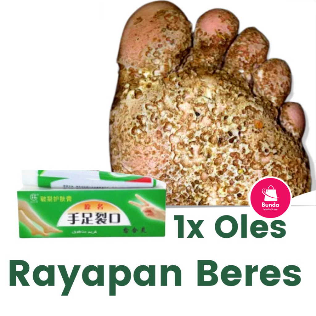 Obat Telapak Kaki Rayapan Ori Salep Cina Obat Gatal Ori Obat Kaki Rayapan Dan Bau Salep Kaki Pecah D