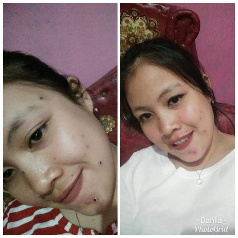 penghilang tahilalat kutil mata ikan