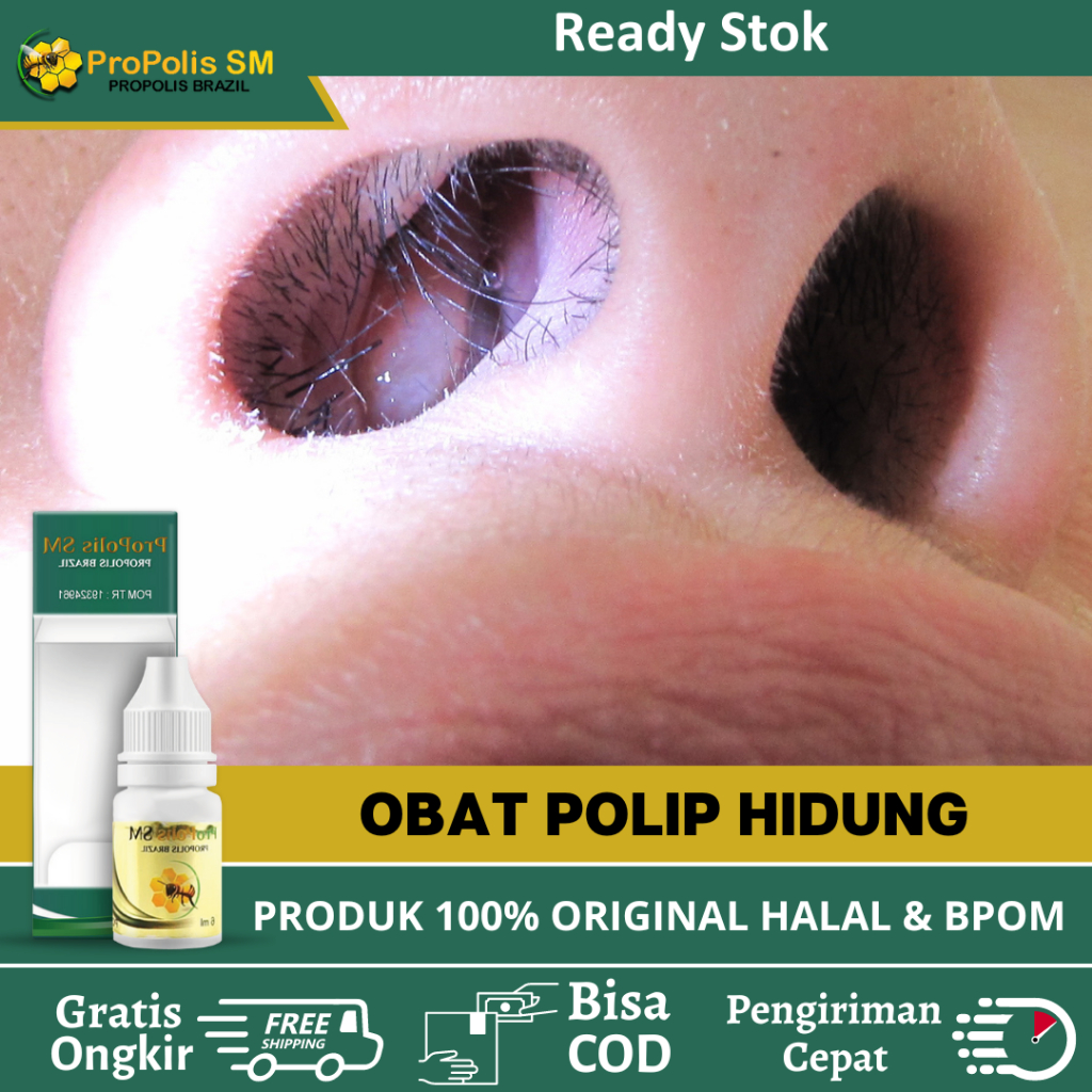 Obat Tetes Polip Hidung, Obat Penyakit Polip Hidung, Perontok Benjolan Di Dalam Hidung, Polip Sinusi