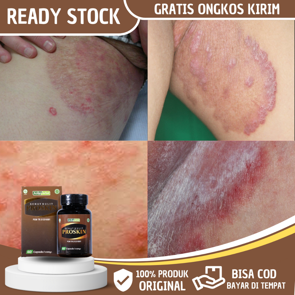 Obat Gatal Selangkangan Pria, Obat Gatal Selangkangan Wanita, Obat Selangkangan Hitam, Obat Gatel Se