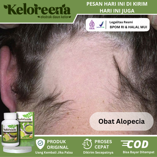 Obat Alopecia Areata, Obat Pitak, Obat Botak Koin, Obat Penumbuh Rambut Botak, Obat Rambut Pitak, Ob