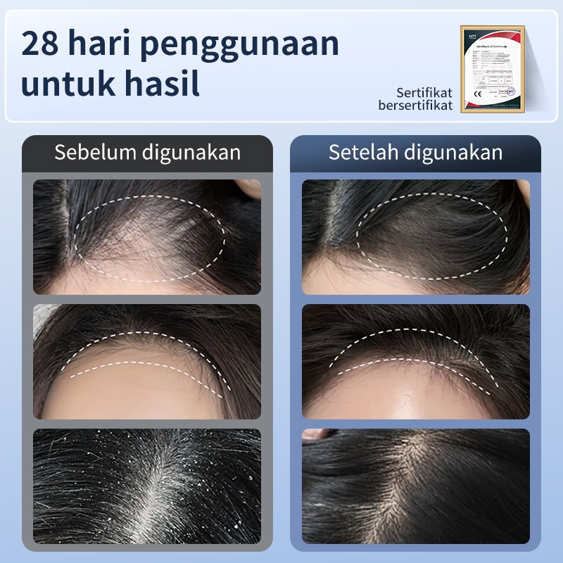 AmazeFan Mengubah Hidup- Sisir Anti Rontok dan Pendorong Pertumbuhan Rambut dengan Cahaya dan Pijatan, Membersihkan Ketombe dan Merawat Kesehatan Rambut dan Kulit Kepala sisir anak perempuan sisir rambut pria sisir pria sisir anti kusut sisir ketombe