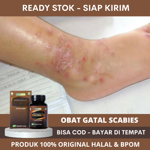 Obat Gatal Scabies, Obat Gatal Scabies Manusia, Obat Scabies Untuk Manusia, Obat Pembasmi Kudis Scab