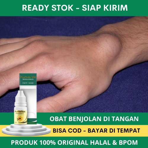 Obat Benjolan di Tangan, Obat Benjolan di Tangan dan kaki, Obat Benjolan Keras di Tangan, Obat Pengh