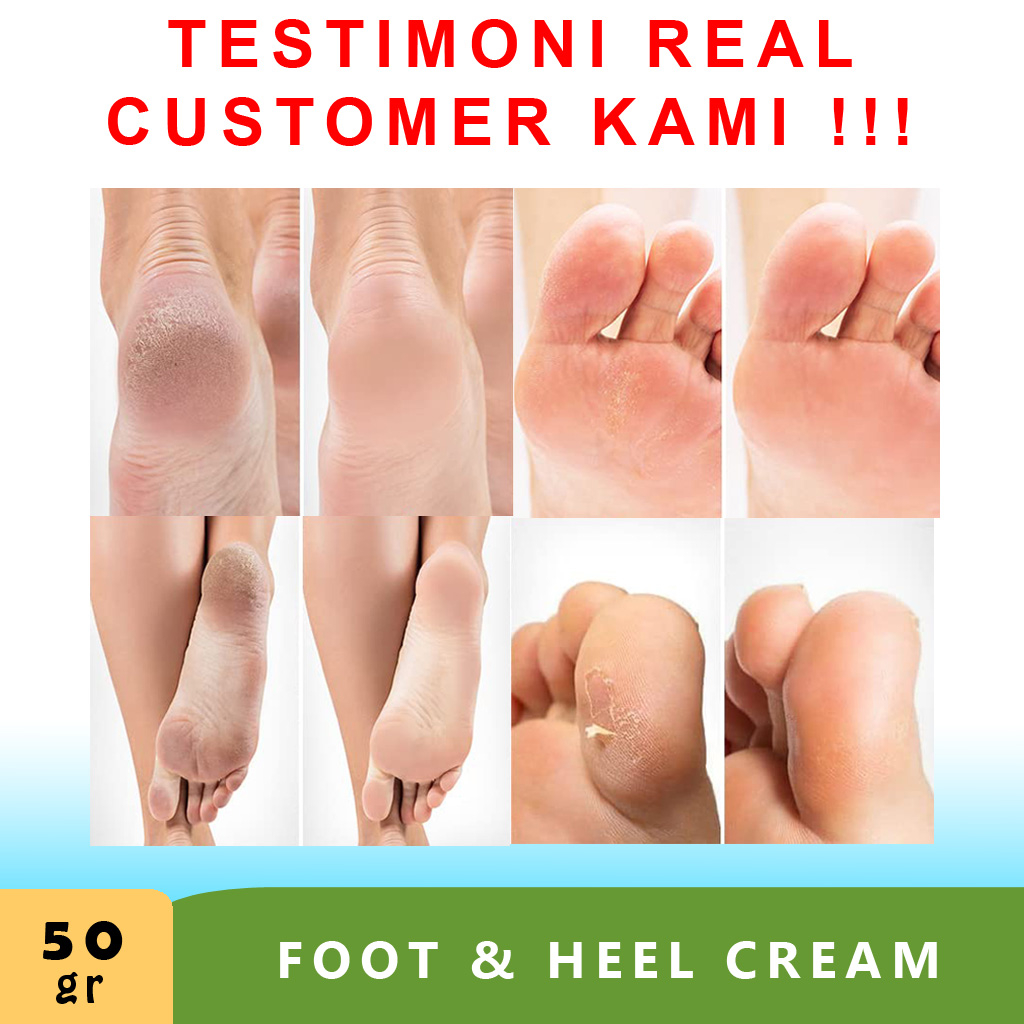 Obat Kaki Pecah Dan Kering Foot Cream Penghalus Tumit Kaki Cream Kaki Pecah2 B10A