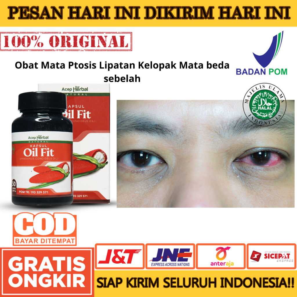 Obat Mata Ptosis Lipatan Kelopak Mata beda sebelah mata sipit sebelah Gangguan Pada Kelopak Mata, Ob