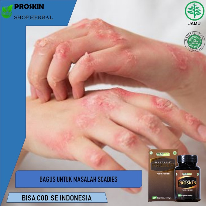 obat scabies obat scabies manusia  Proskin Obat Gatal Scabies, Obat Gatal Kulit Scabies Manusia, Oba