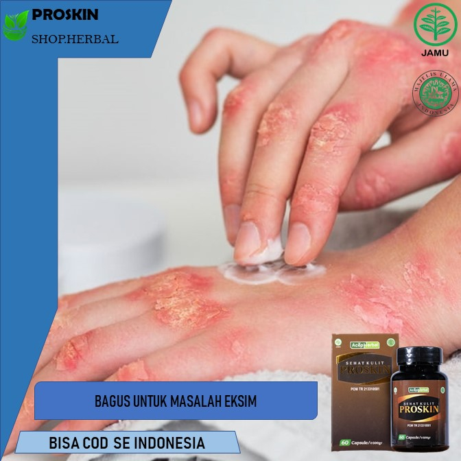 obat eksim  obat eksim kering  Obat Gatal Eksim Obat Kulit Eksim, Obat Eksim dan Basah, Obat Eksim M