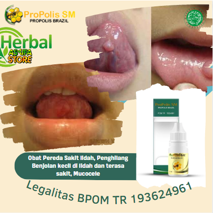 Obat Pereda Sakit lidah, Penghilang Benjolan kecil di lidah dan terasa sakit, Mucocele, benjolan put