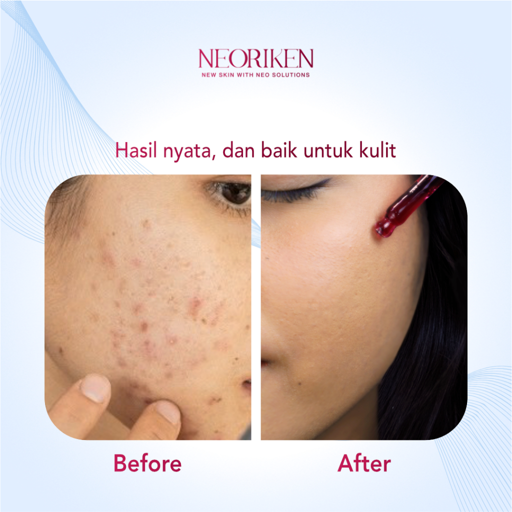 Neoriken Paket Skincare - Anti Aging Set, Acne Set, Glowing Set, Basic Skincare Set, Exfoliating Set, &amp; Anti Darkspot Set