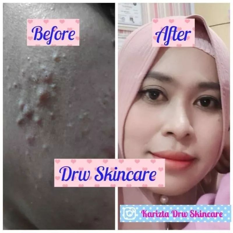 SERUM ACNE/JERAWAT drw skincare