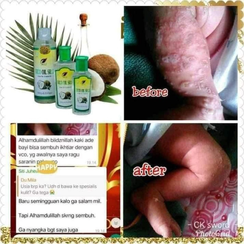 MINYAK KELAPA ASLI , VCO OIL , VCO SR12 , MENGATASI CRADLE CRAP PADA BAYI , OBAT ALERGI BAYI , MINYAK URUT BAYI