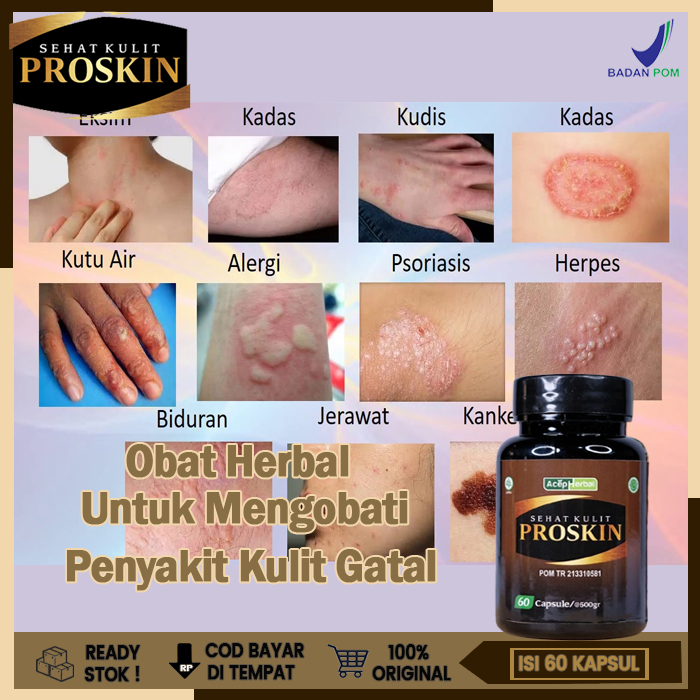 Obat Gatal Kulit, Obat Gatal Kulit Paling Aman, Obat Alergi Gatal Kulit , Obat Gatal Gatal, Obat Gat