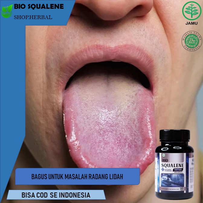 Obat Radang Lidah, Lidah Putih, Lidah Berjamur, Lidah Pahit Obat Radang Lidah | Penghilang Luka Saki