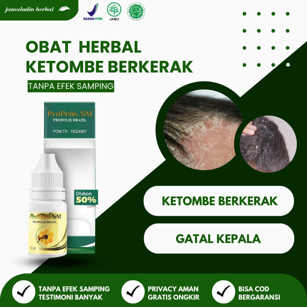 OBAT HERBAL JAMUR KULIT DI KEPALA ANAK DAN DEWASA - PROPOLIS SM ORIGINAL