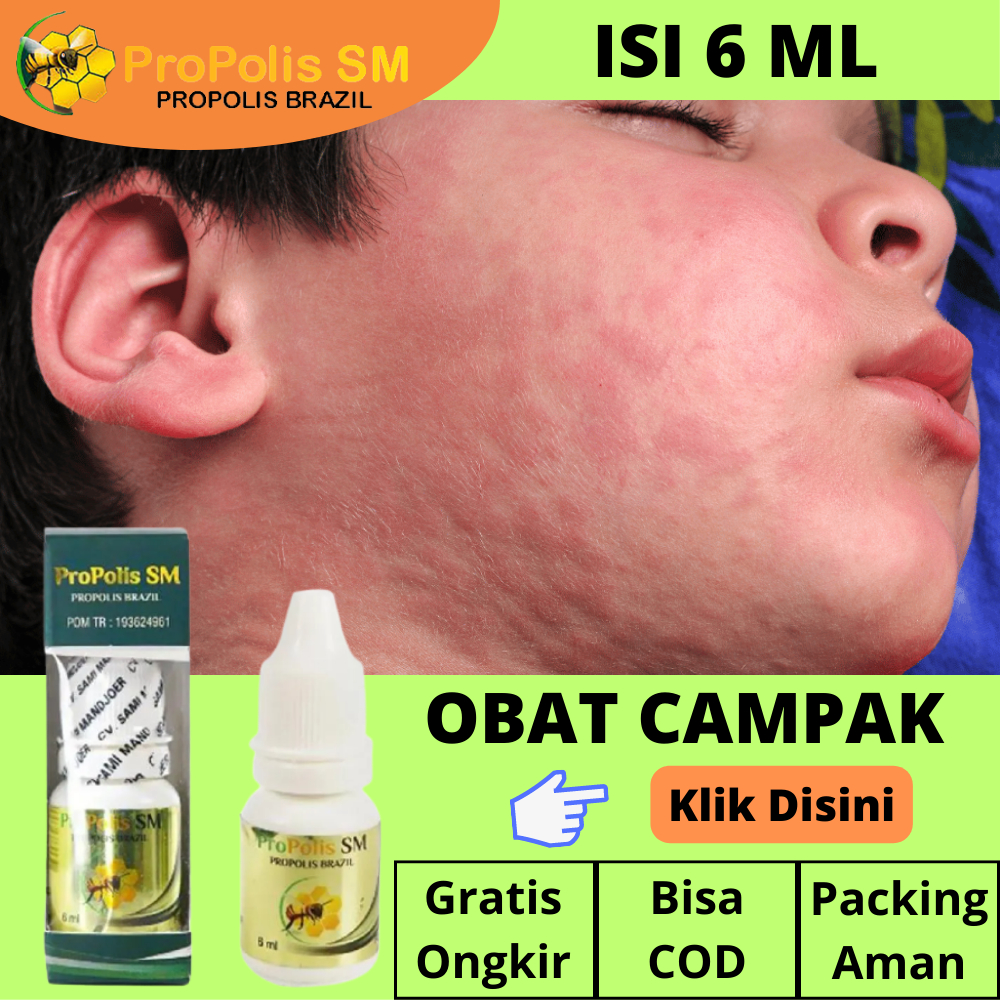 Obat Campak Anak, Campak Rubella, Tampek, Gabagean, Gabakan, Penyakit Campak Ringan Parah, Cacar Api