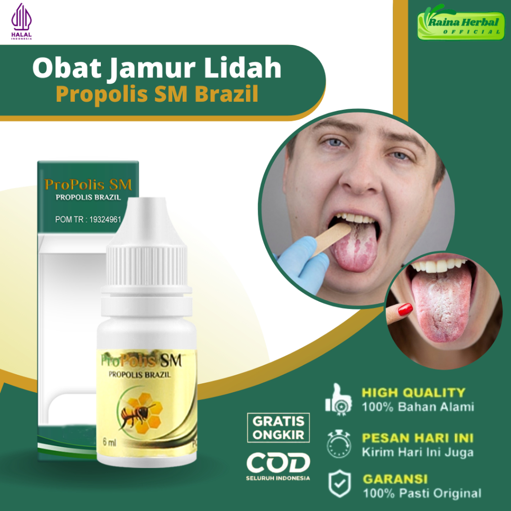 Obat Lidah Putih, Obat Lidah Berjamur, Obat Kandidiasis Mukokutan, Obat Lidah Pecah Pecah, Obat Lida