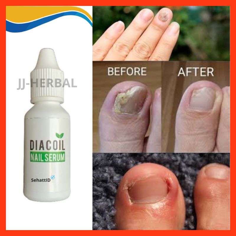 DIACOIL NAIL SERUM OBAT PENGHILANG JAMUR KUKU BERNANAH DAN CANTENGAN