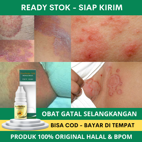 Obat Gatal Selangkangan, Obat Selangkangan Hitam, Pemutih Selangkangan, Salep Gatal Selangkangan, Ob
