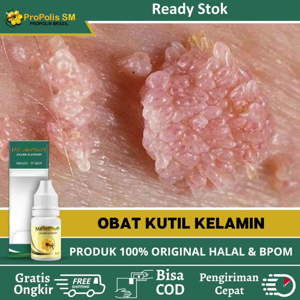 Obat Kutil Kelamin HPV, Obat Kutil Kelamin, Obat Kutil Anus Pria / Wanita, Obat Kutil Kemaluan, Obat