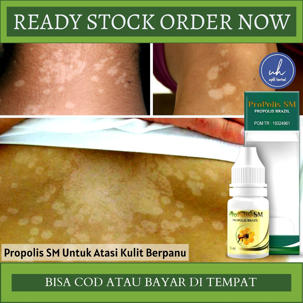 Obat Panu Cair, Obat Oles Panu, Obat Penghilang Panu, Obat Untuk Panu DiKulit, Obat Jamur Kulit Panu