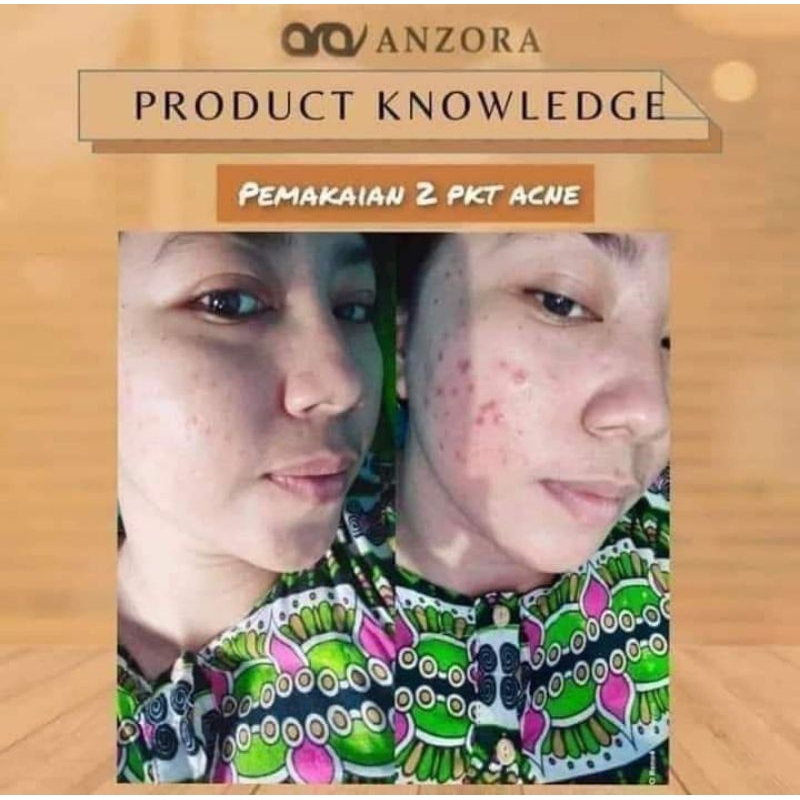 ANZORA SKINCARE ( GLOW SERIES) ACNE SERIES anzora Skincare - skincare anzora original - anzora paket
